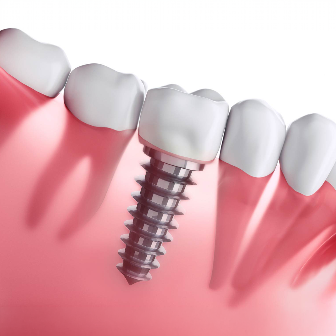 Dental Implant