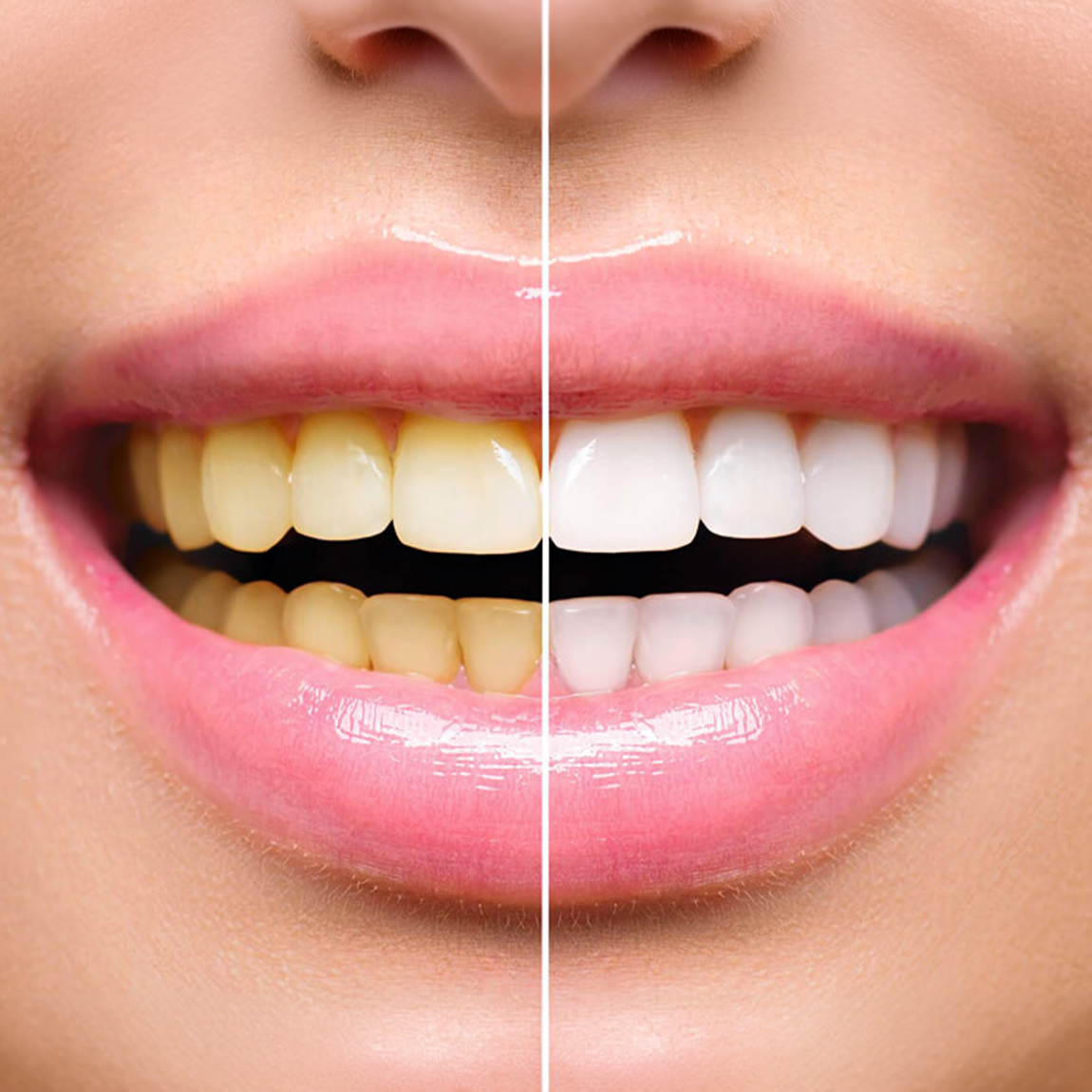 Teeth Whitening