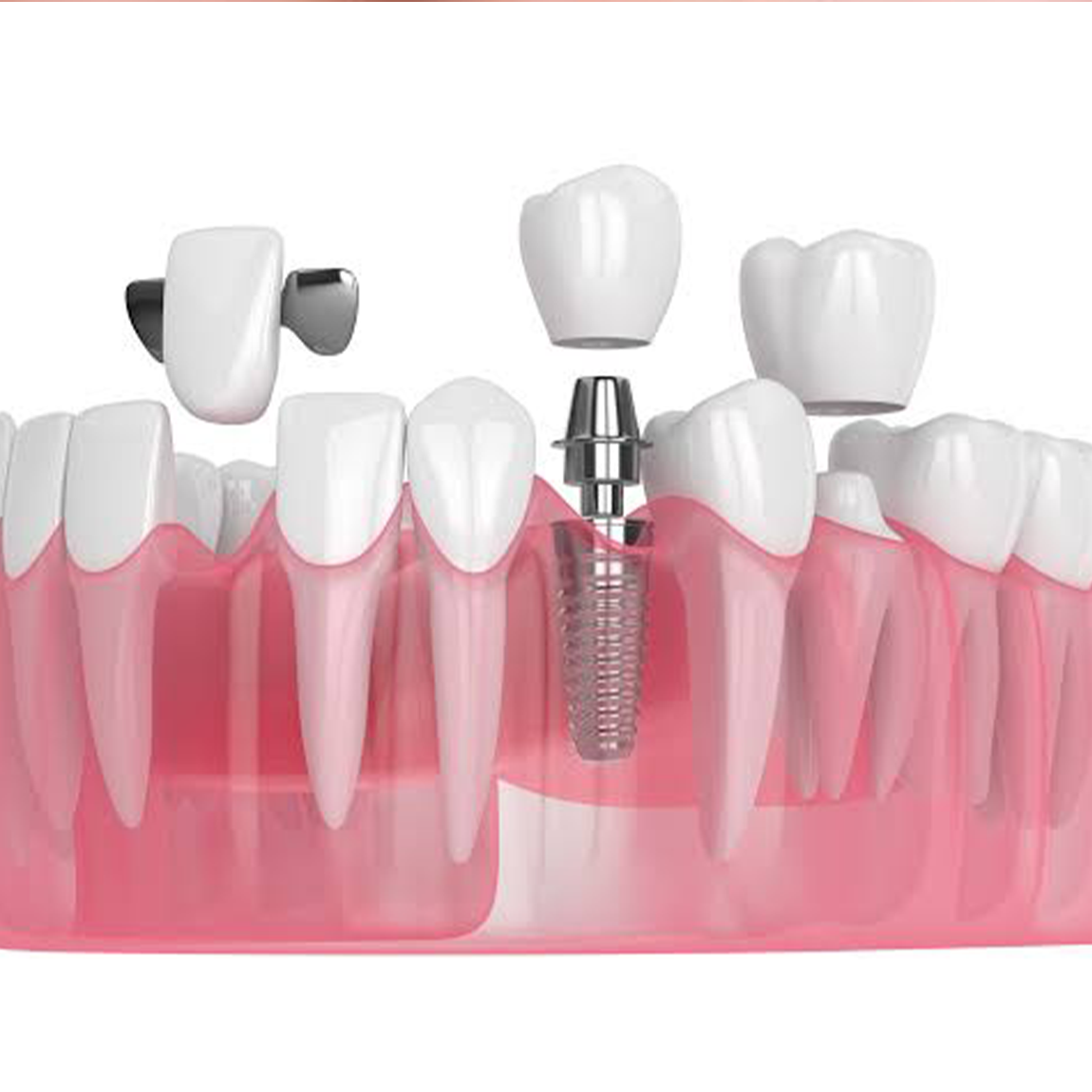 Dental Prosthesis