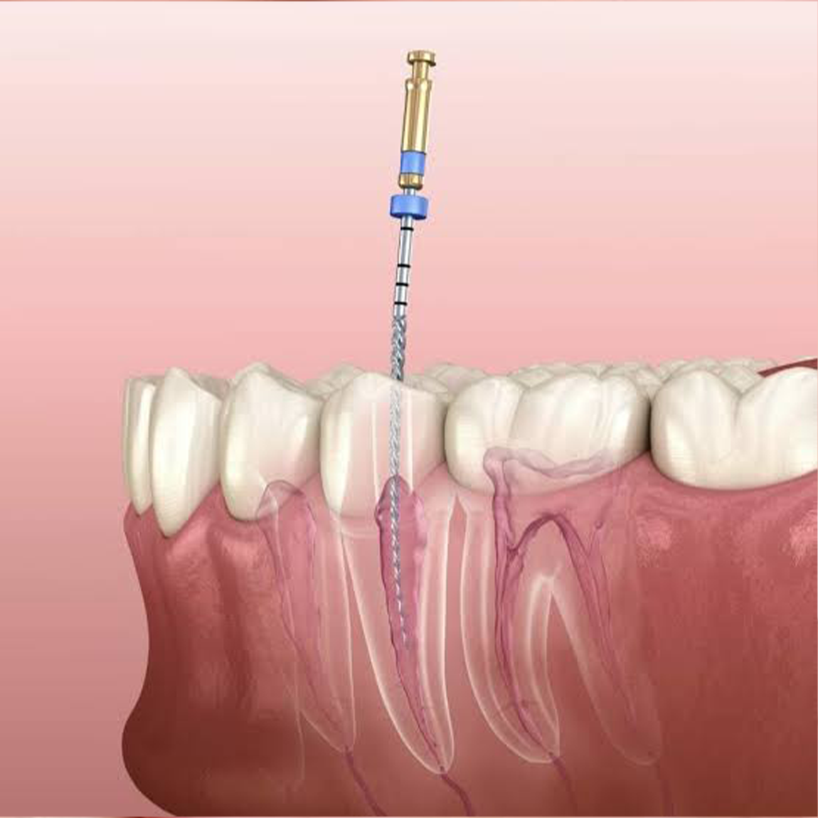 Root Canal Treatment